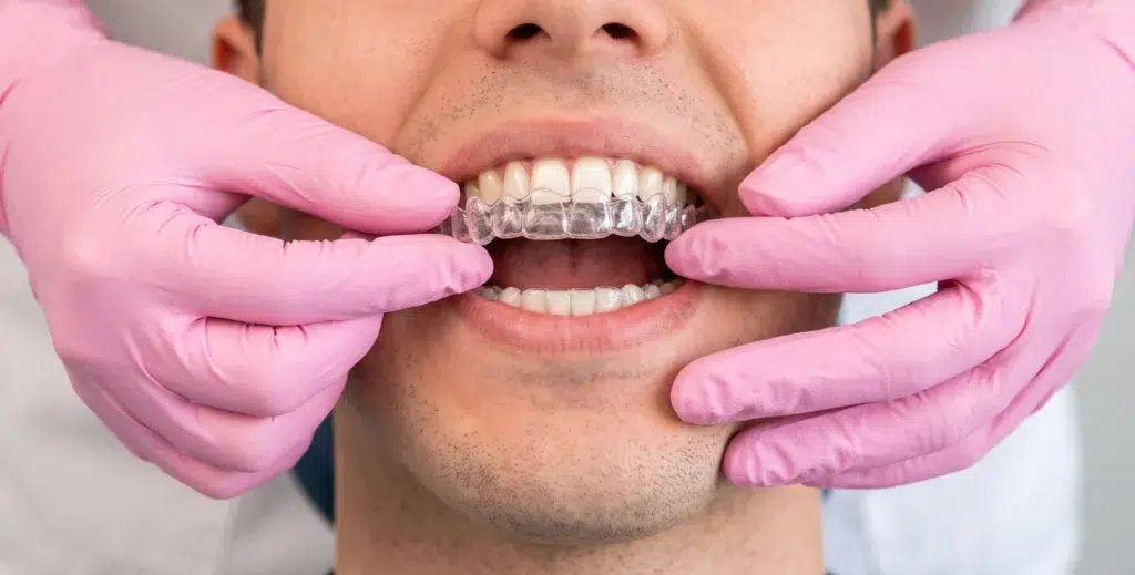 Spark Clear Aligners On A Male Patient